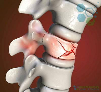 stem-cell-treatment-spinal-compression-fracture