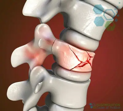 stem-cell-treatment-spinal-compression-fracture