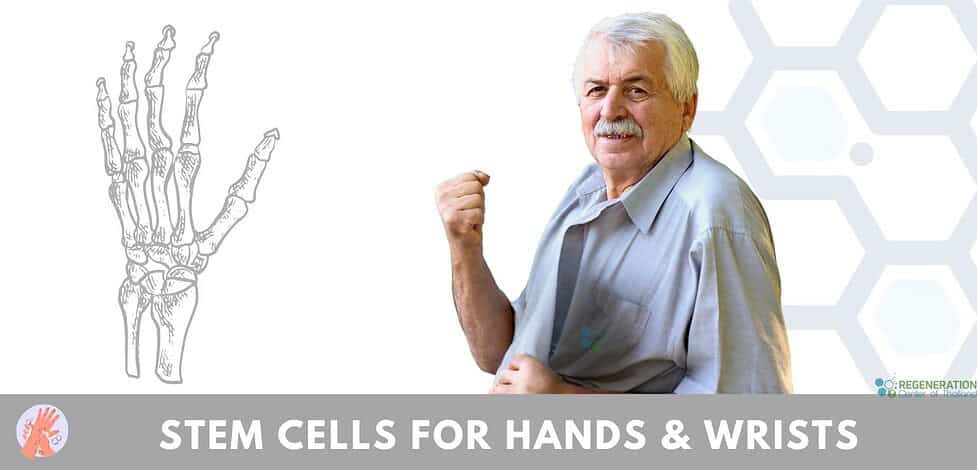 Stem Cell Treatment for hand injuries hand arthritis wrist pain