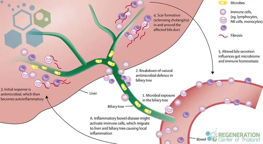tem-cell-therapy-for-Primary-Sclerosing-Cholangitis