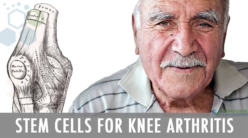 stem-cell-treatment-knee-arthritis-regeneration-center