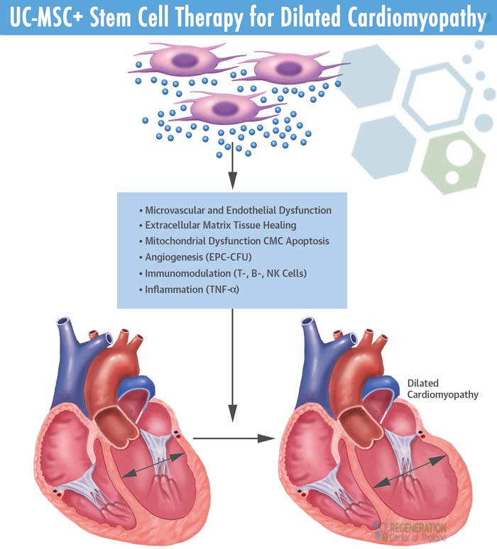 dilated-cardiomyopathy-stem-cell-treatment
