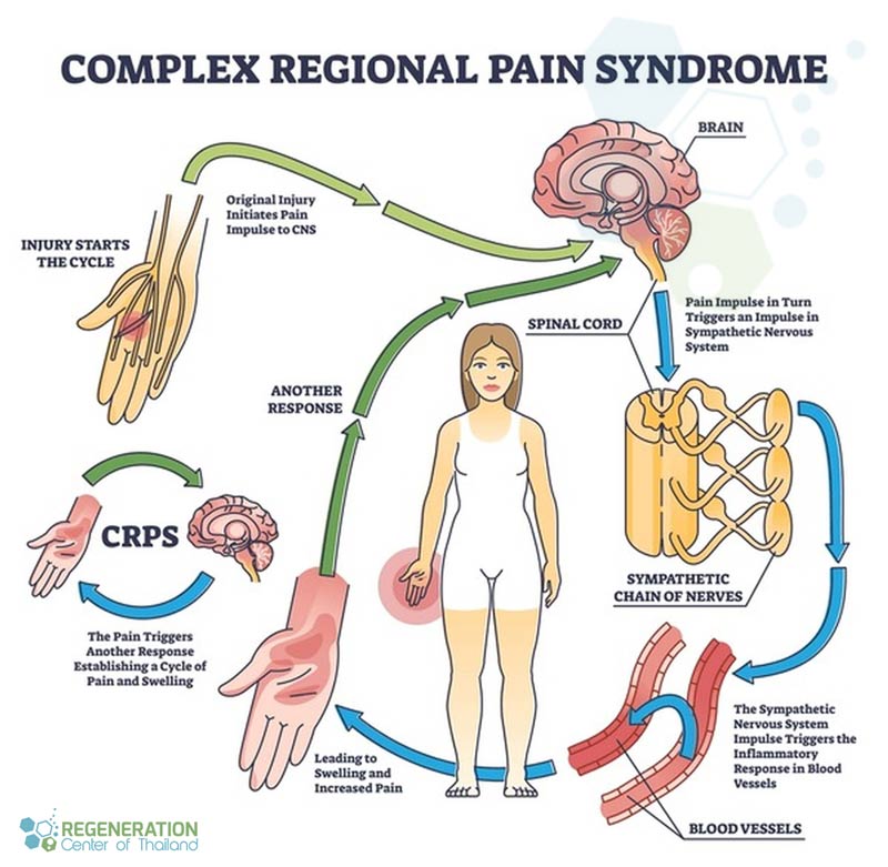 CRPS-treatment-stemcell