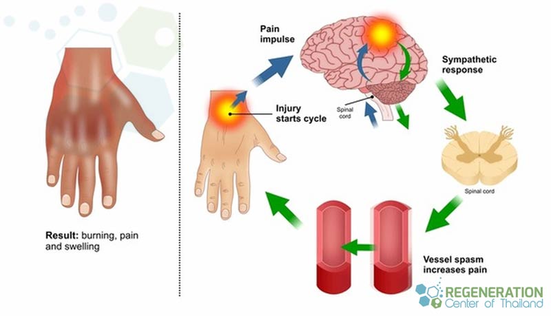 Symptoms-treatment-CRPS-stemcells