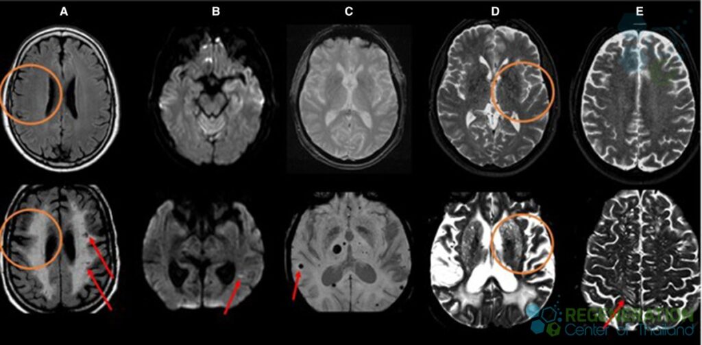 cerebral-small-vessel-disease-mri-lacunes-microbleeds-markers