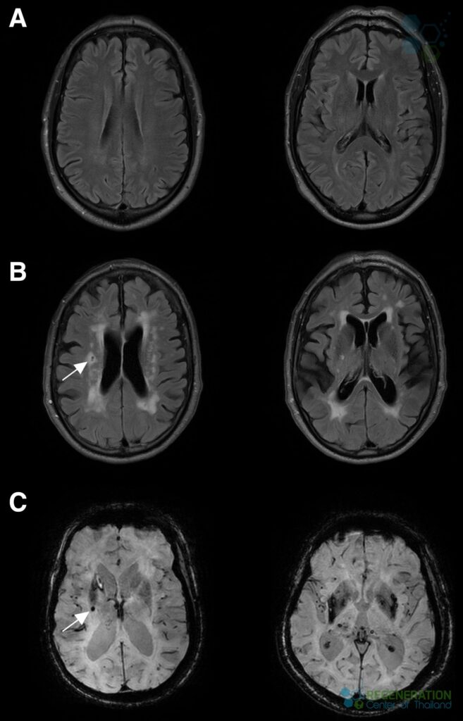 cerebral-small-vessel-disease-mri-white-matter-hyperintensities