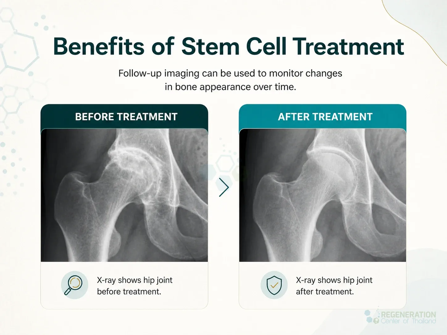 Before-and-after hip X-rays used for clinical follow-up for Sarcopenia: Causes, Symptoms & Stem Cell Regeneration Therapy.