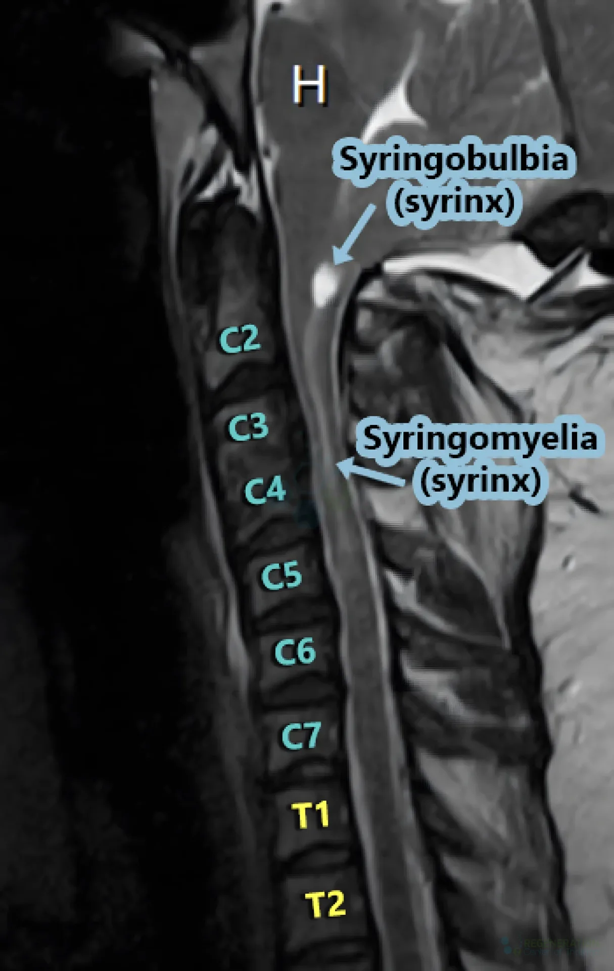 enhanced version of Cervical spine stenosis stemcell therapy β media repair