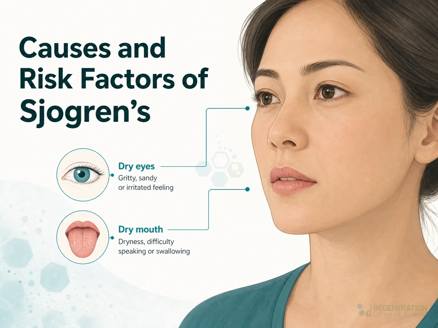Illustration showing dry eyes and dry mouth associated with Sjogren's syndrome for Isolated UC-MSC+ Stem Cell Treatment for Sjogren’s Syndrome.