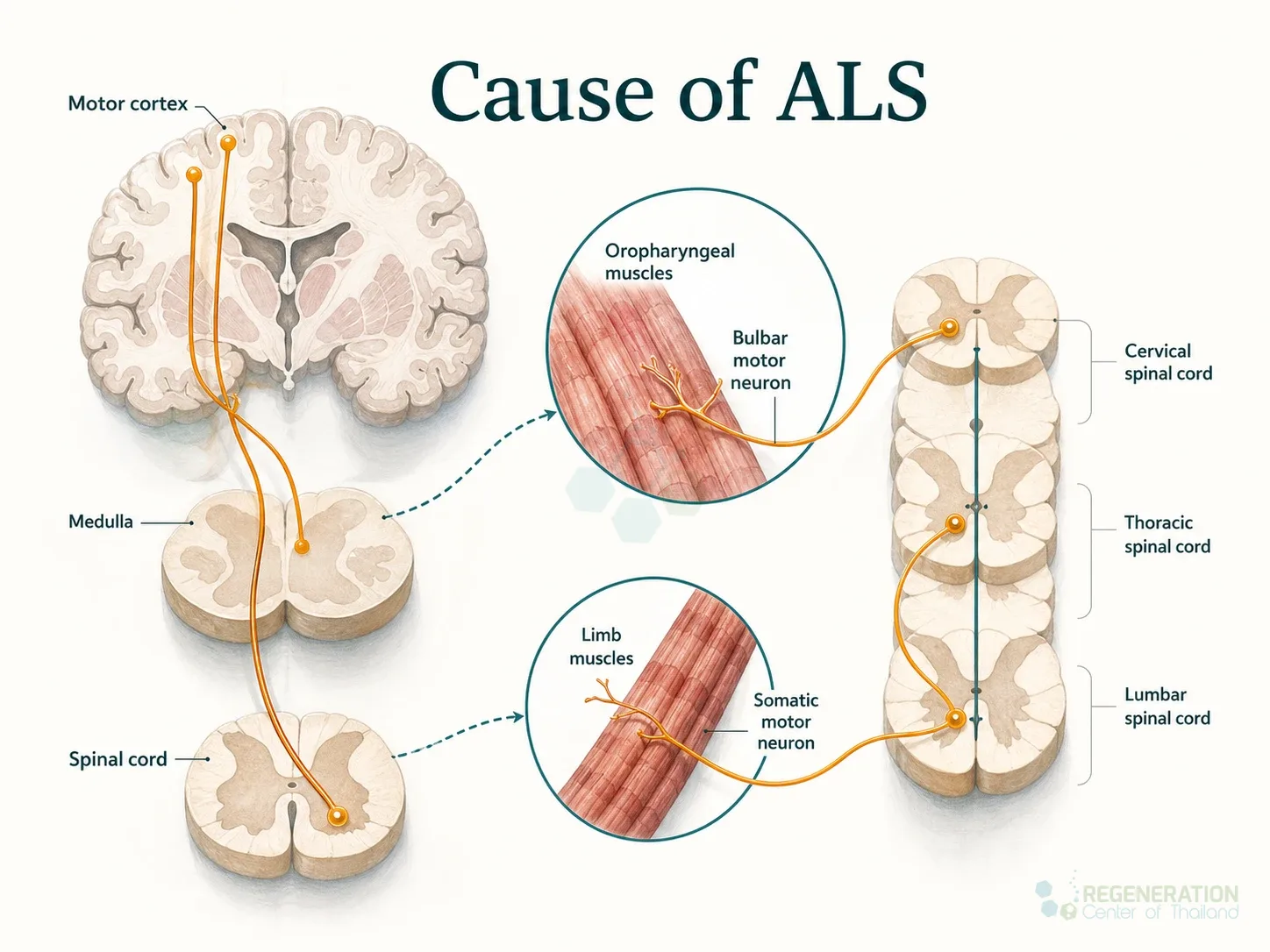 Stem-Cell-Treatment-ALS for Neurogenic Stem Cell Therapy for ALS Neuroinflammation Modulation.