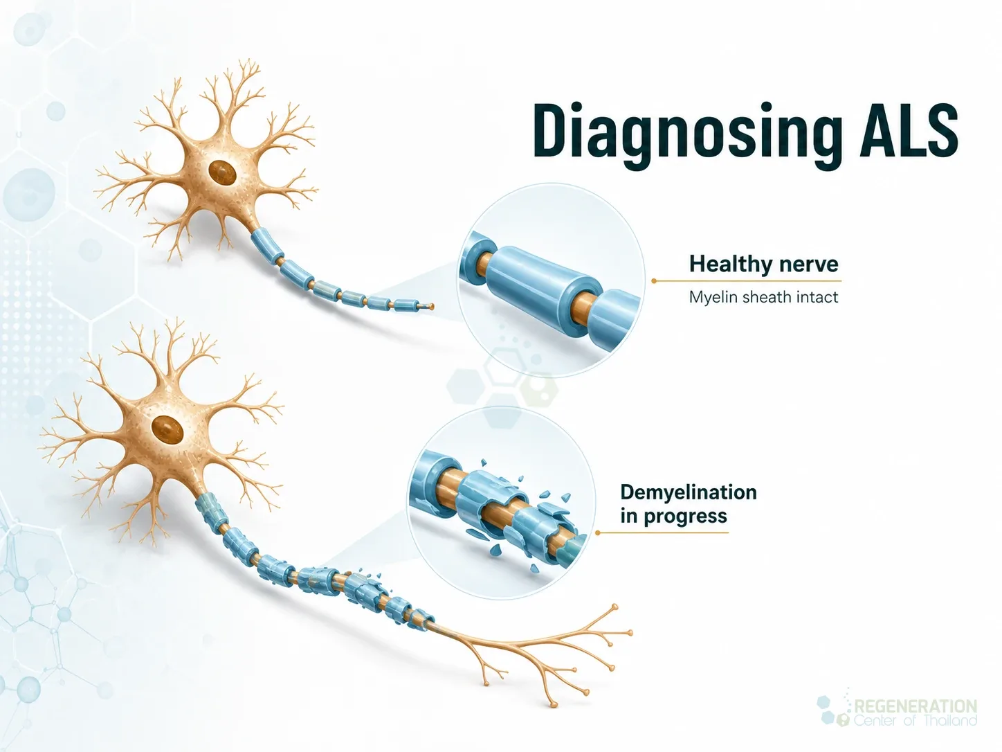 ALS stem cell treatment and neuroinflammation illustration for Neurogenic Stem Cell Therapy for ALS Neuroinflammation Modulation.