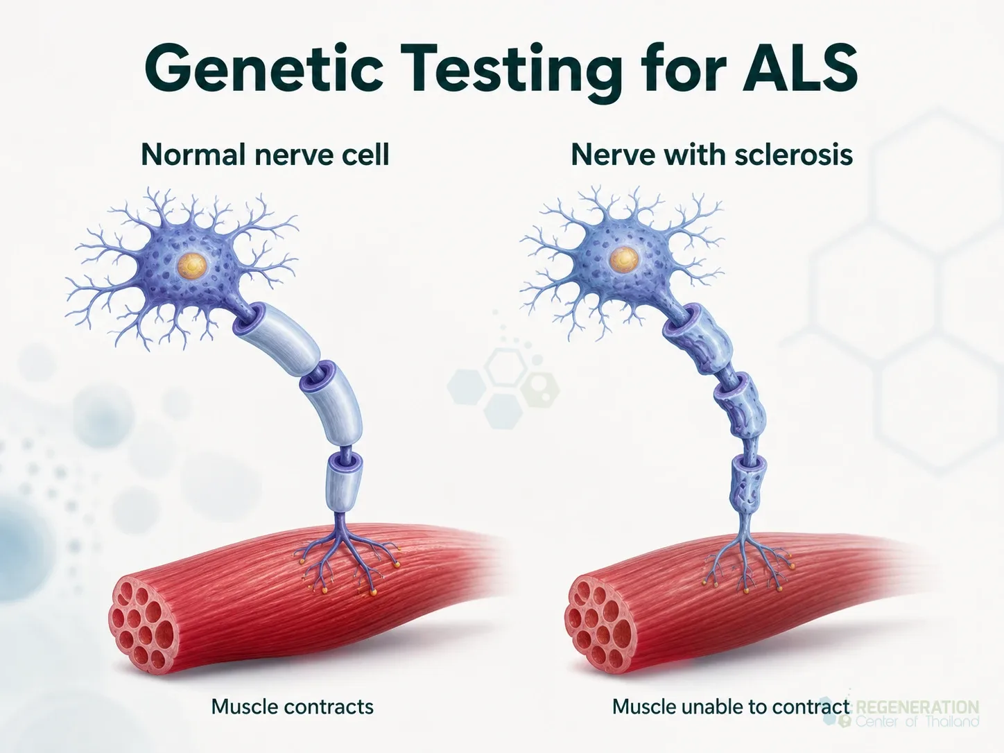 Stem Cell treatment for ALS Lou Gehrig's disease for Neurogenic Stem Cell Therapy for ALS Neuroinflammation Modulation.