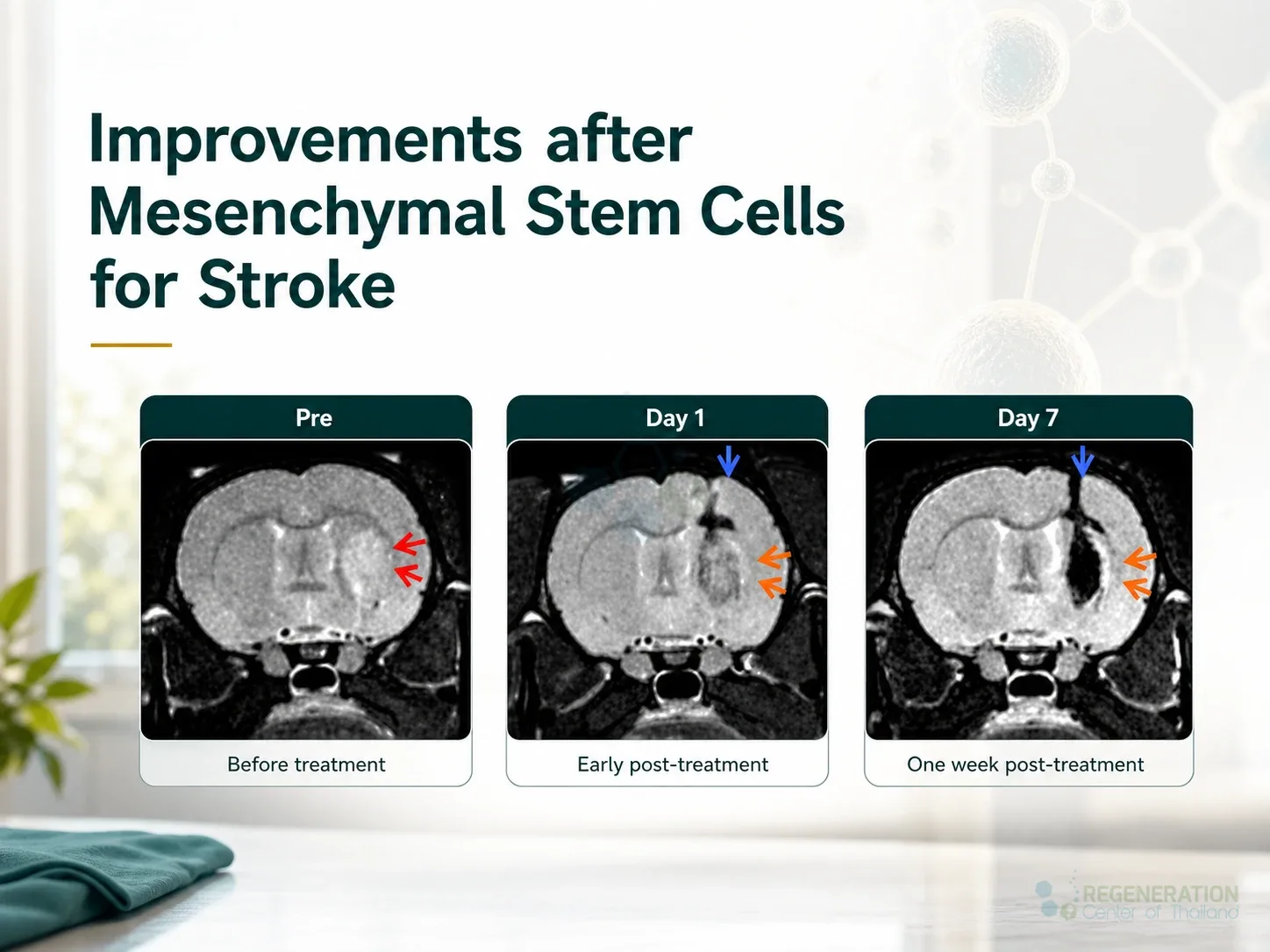 before-after-stem-cell therapy for stroke for Neurogenic Stem Cell Treatment For Stroke Recovery.