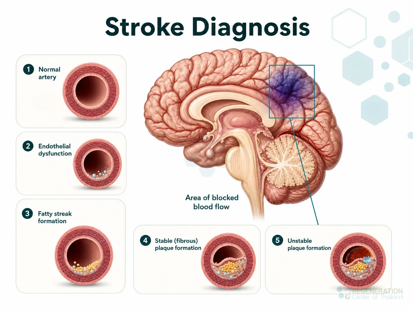 stroke-treament-tissue-plasminogen-activator for Neurogenic Stem Cell Treatment For Stroke Recovery.