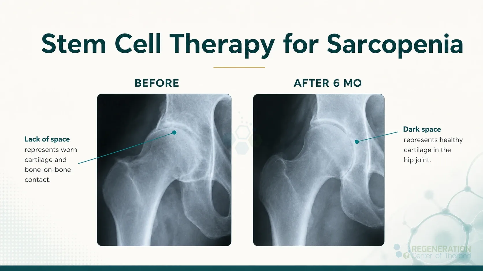 Hip X-rays comparing joint space before treatment and at six months for Sarcopenia: Causes, Symptoms & Stem Cell Regeneration Therapy.