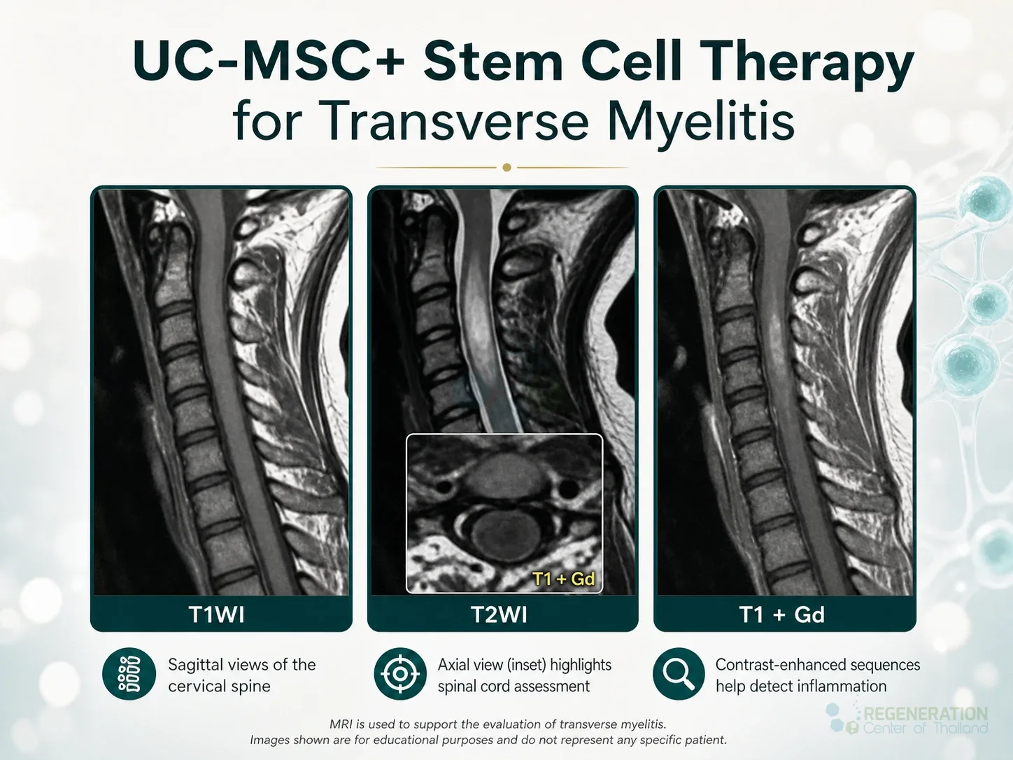 Cervical spine MRI scans used to assess transverse myelitis for Spine Inflammation & Stem Cell Therapy for Transverse Myelitis.