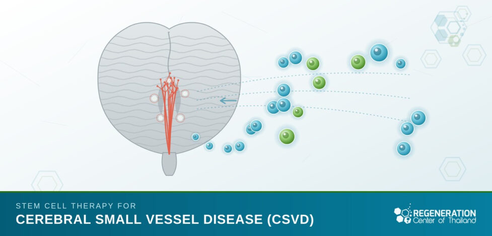 stem-cell-therapy-cerebral-small-vessel-disease-csvd-