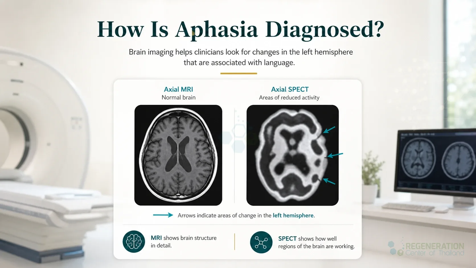 Brain scans labeled with right- and left-hemisphere changes for Stem Cell Therapy for Aphasia – A New Approach.