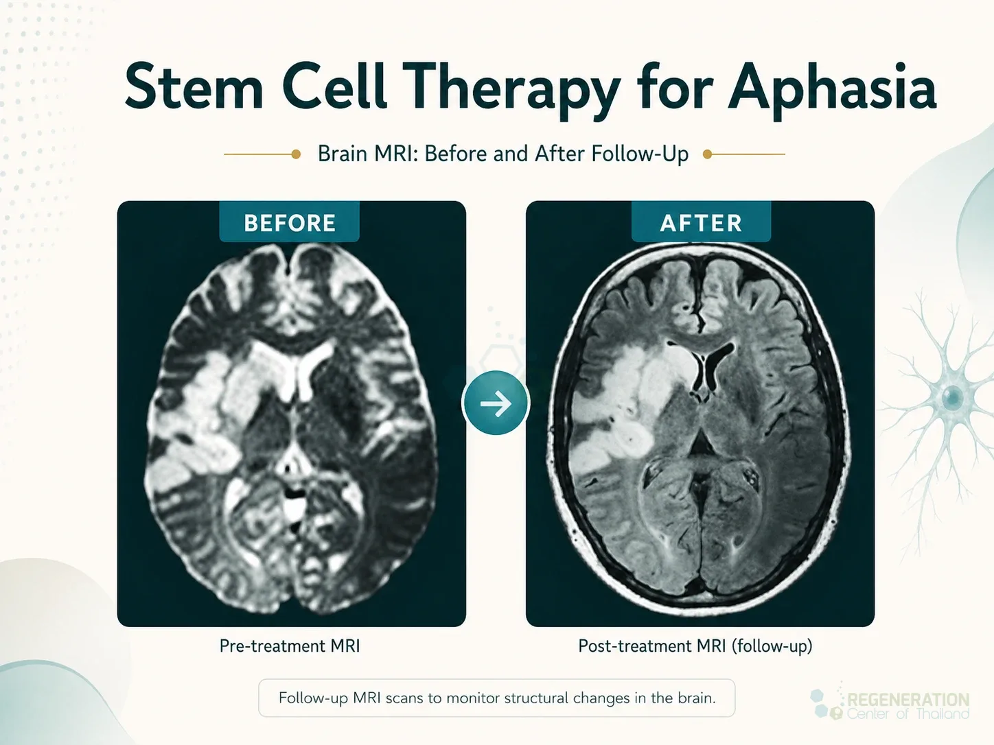 Before-and-after brain MRI scans used in aphasia follow-up for Stem Cell Therapy for Aphasia – A New Approach.