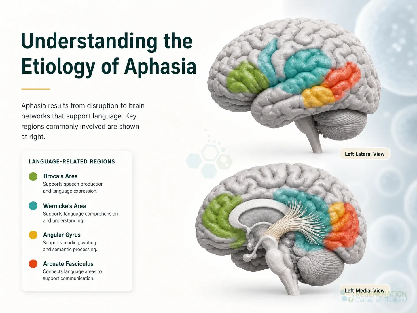 Three-dimensional brain model highlighting regions involved in language for Stem Cell Therapy for Aphasia – A New Approach.
