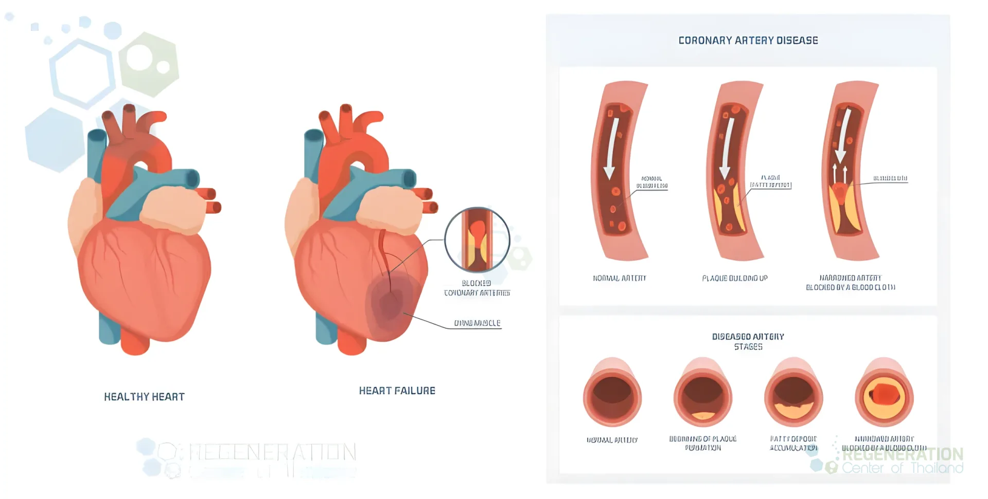 Diagram comparing a healthy heart with heart failure and showing coronary artery narrowing from plaque buildup