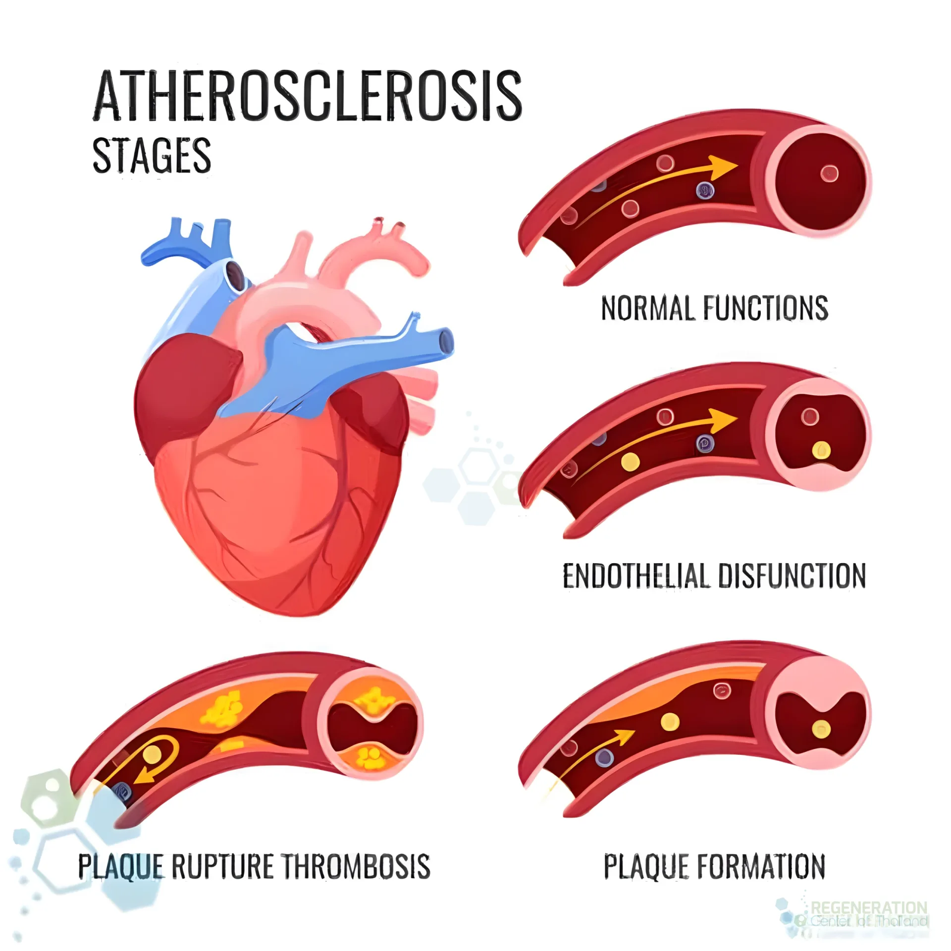 Illustration of atherosclerosis stages from normal artery function through plaque formation and thrombosis