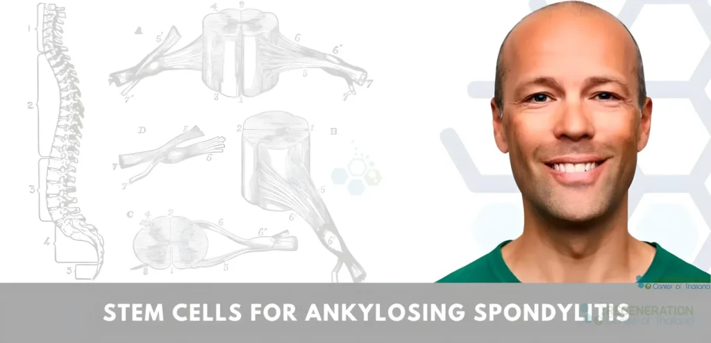 enhanced version of Stem Cell Treatment for ankylosing spondylitis stage 4 Advanced – media repair
