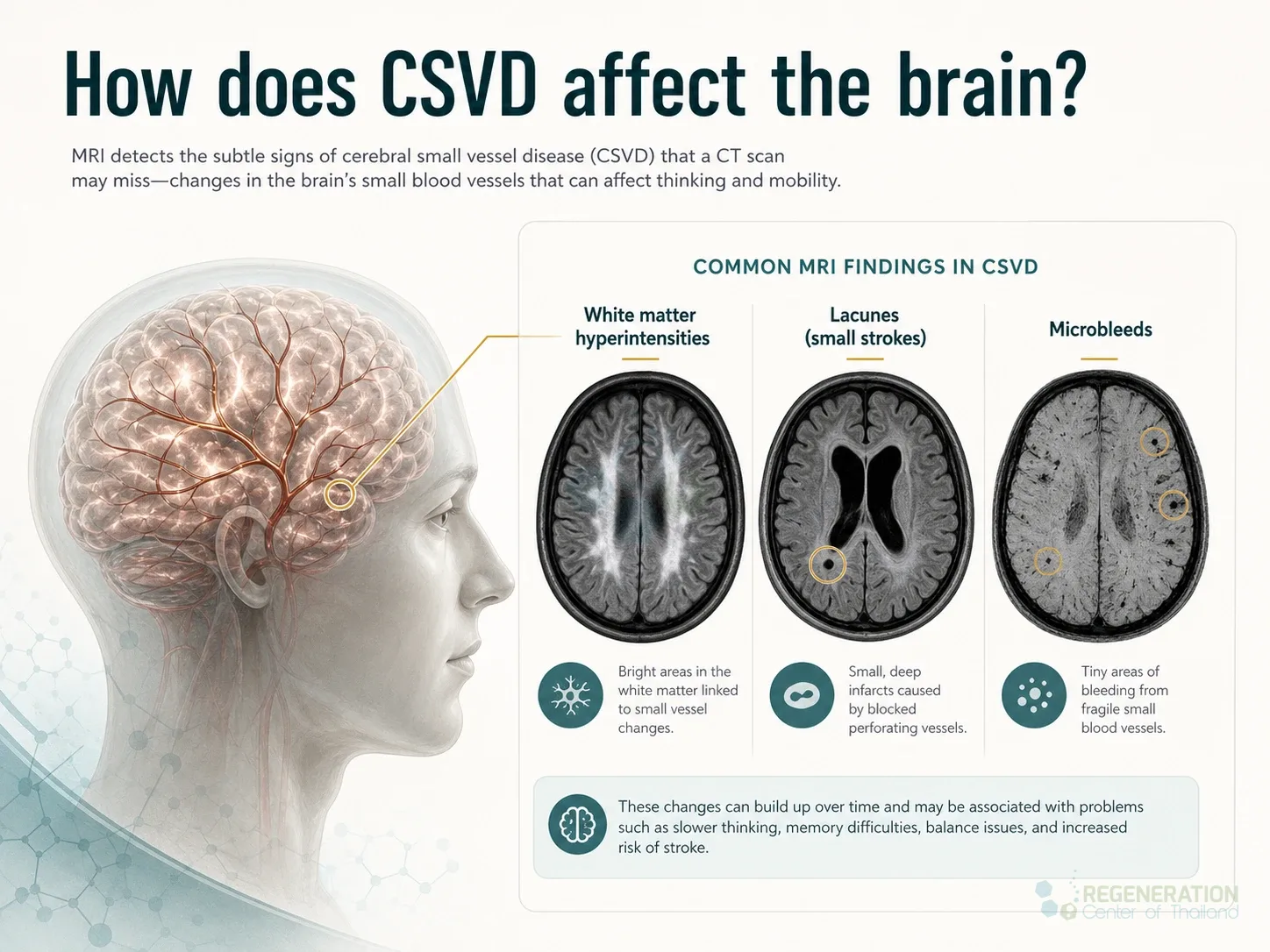 cerebral-small-vessel-disease-mri-white-matter-hyperintensities for Stem Cell Treatment for Cerebral Small Vessel Disease (CSVD).