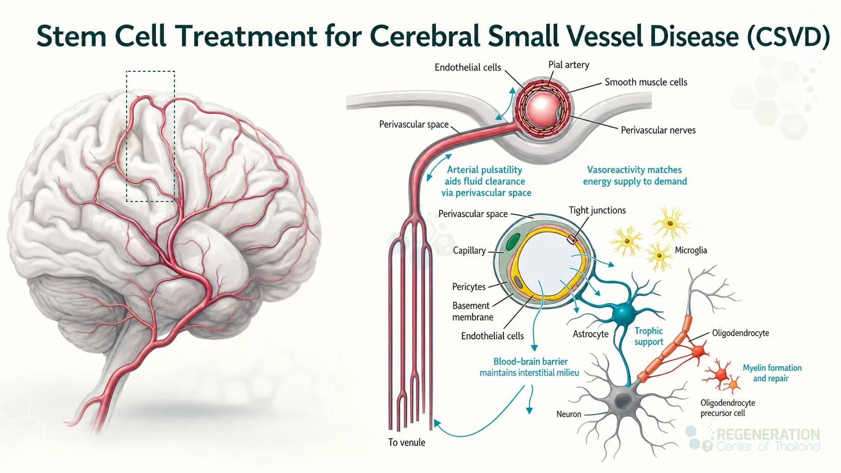 stem-cell-therapy-cerebral-small-vessel-disease-neurovascular-repair for Stem Cell Treatment for Cerebral Small Vessel Disease (CSVD).