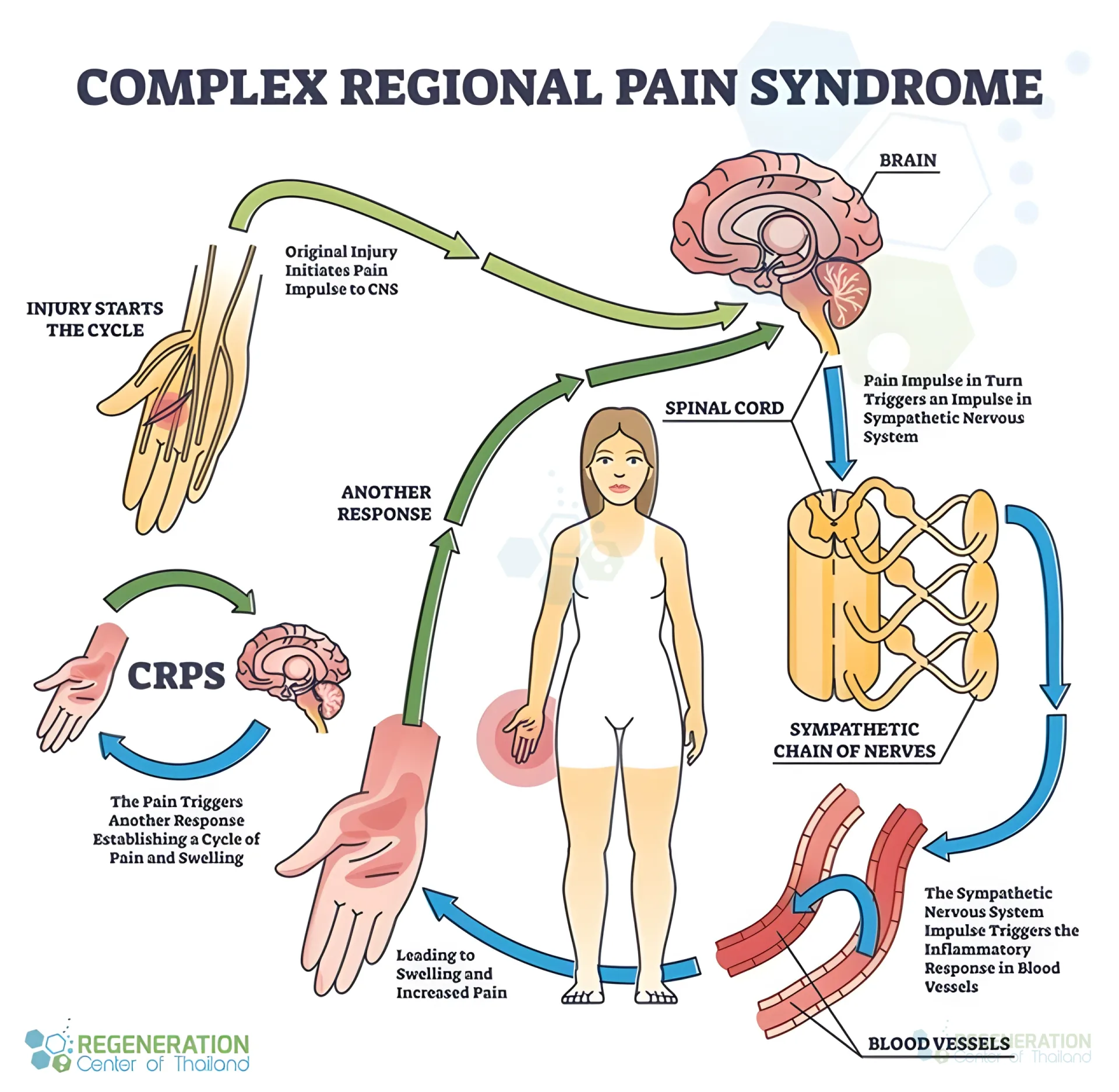 Enhanced visual alternative for CRPS-treatment-stemcell