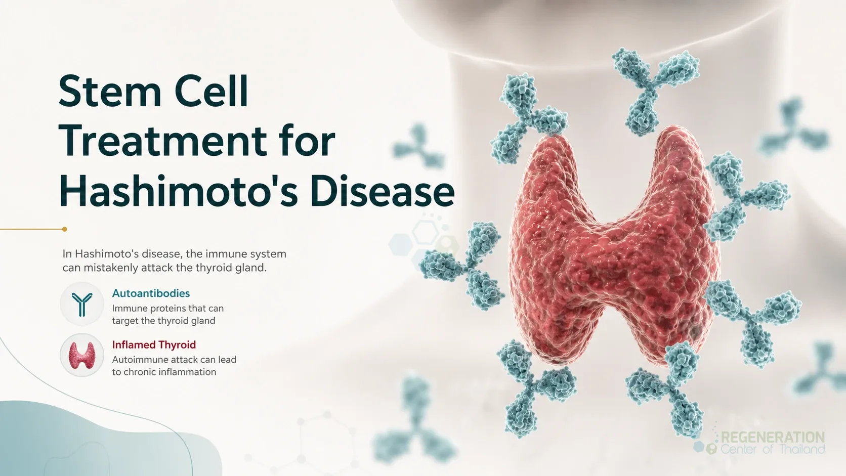 Medical illustration of antibodies surrounding an inflamed thyroid gland for Stem Cell Treatment for Hashimoto’s Disease & Chronic Thyroiditis.