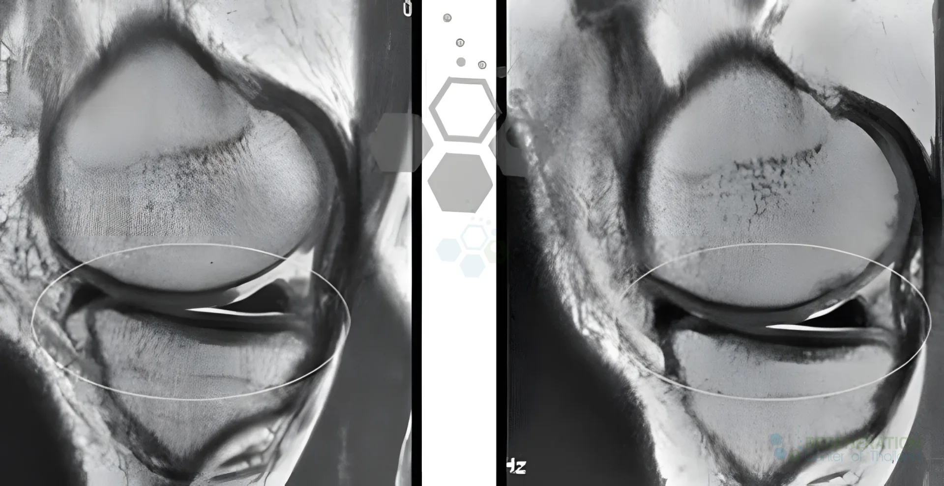 Side-by-side knee MRI scans with the cartilage and joint space highlighted