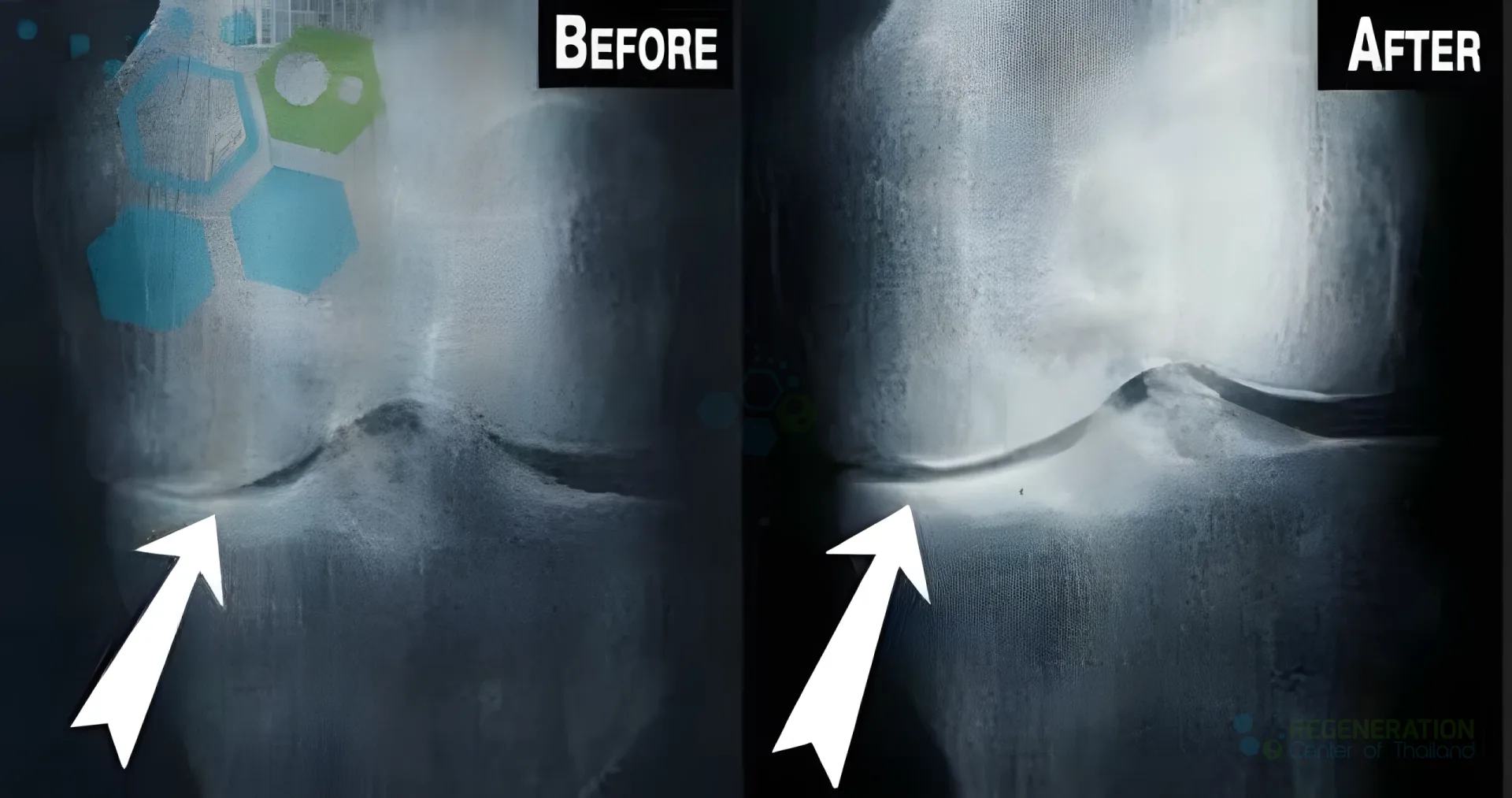 Before-and-after knee radiographs highlighting differences in the joint space