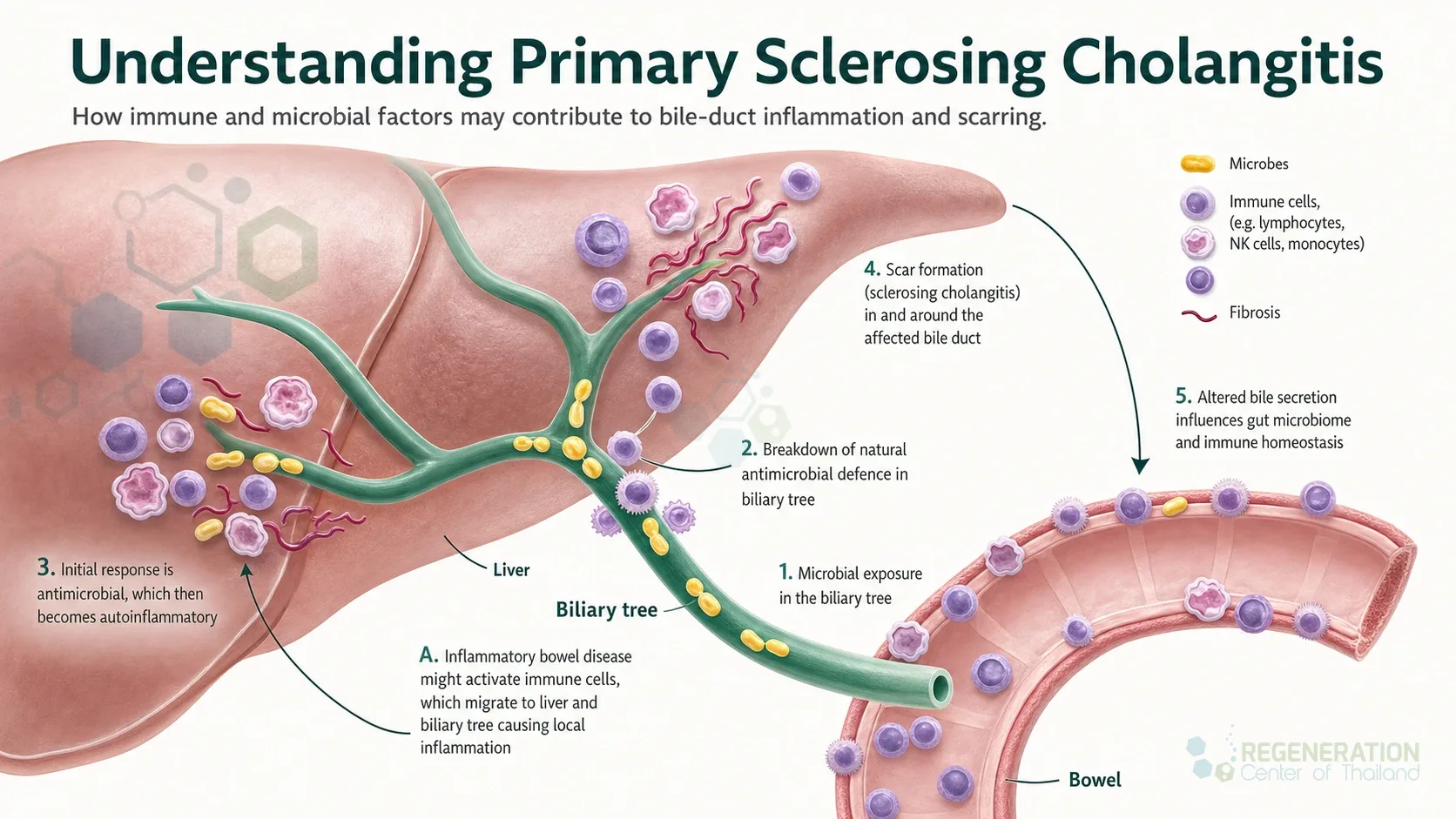 tem-cell-therapy-for-Primary-Sclerosing-Cholangitis for Stem Cell Treatment for Primary Sclerosing Cholangitis ( PSC ).