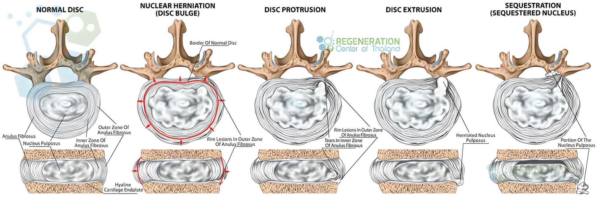 Unapproved enhanced version of stem-cells-herniated-discs