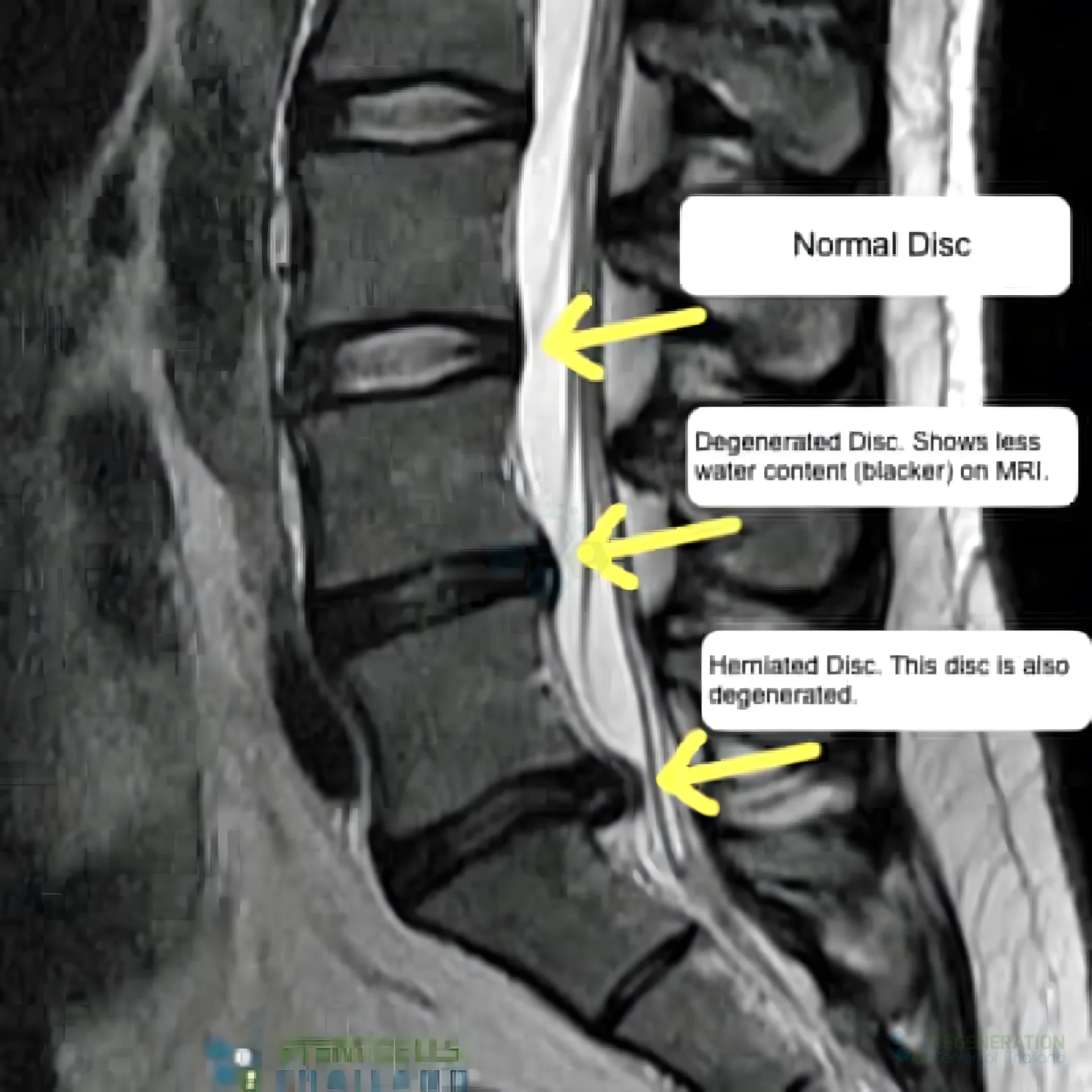 Unapproved enhanced version of DDD-Before-After-treatment-MRI – media repair