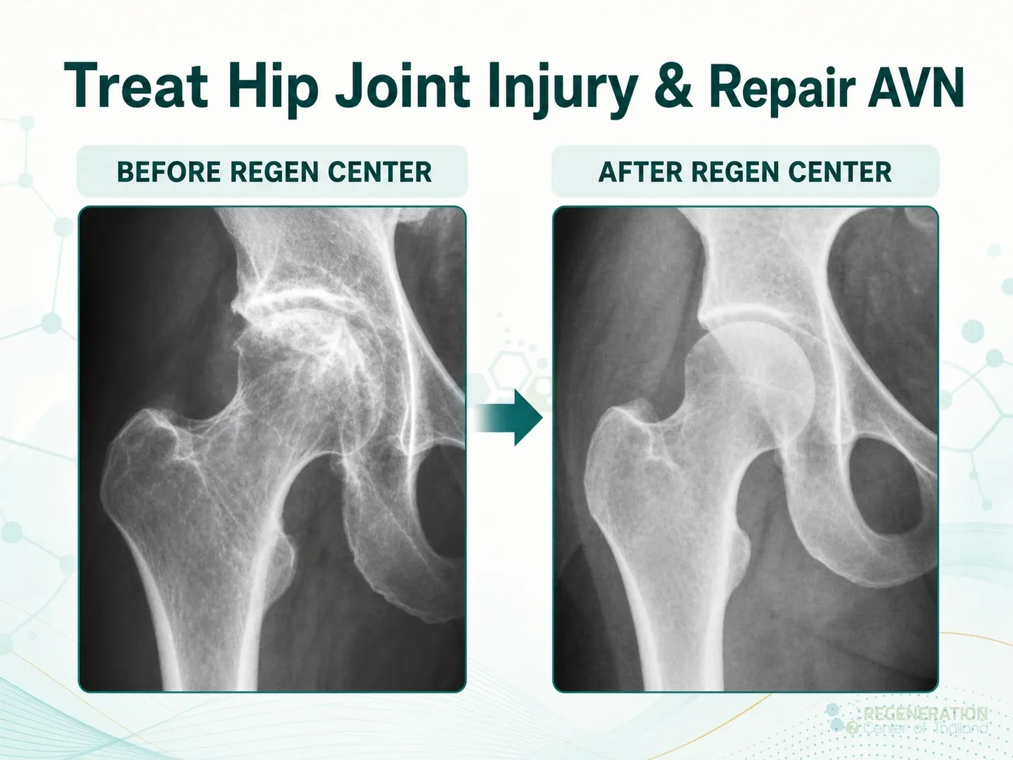 Editorial image for Treat Hip Joint Injury & Repair AVN, including the section headline.