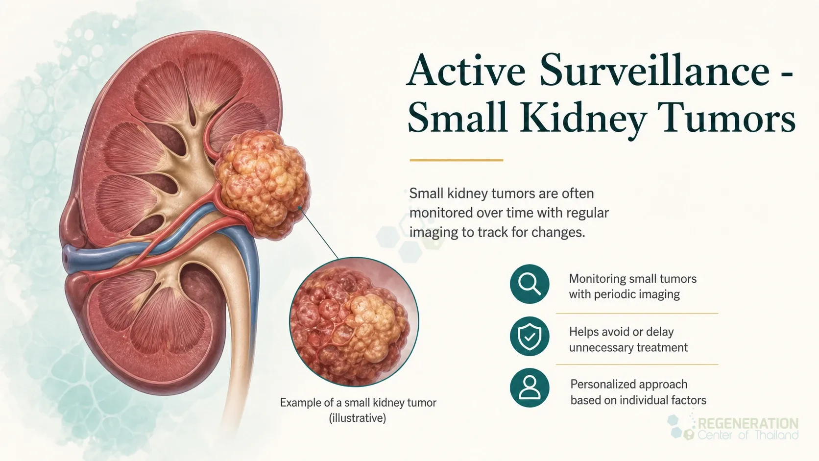 Clean clinical illustration for Active Surveillance - Small Kidney Tumors with concise explanatory text.