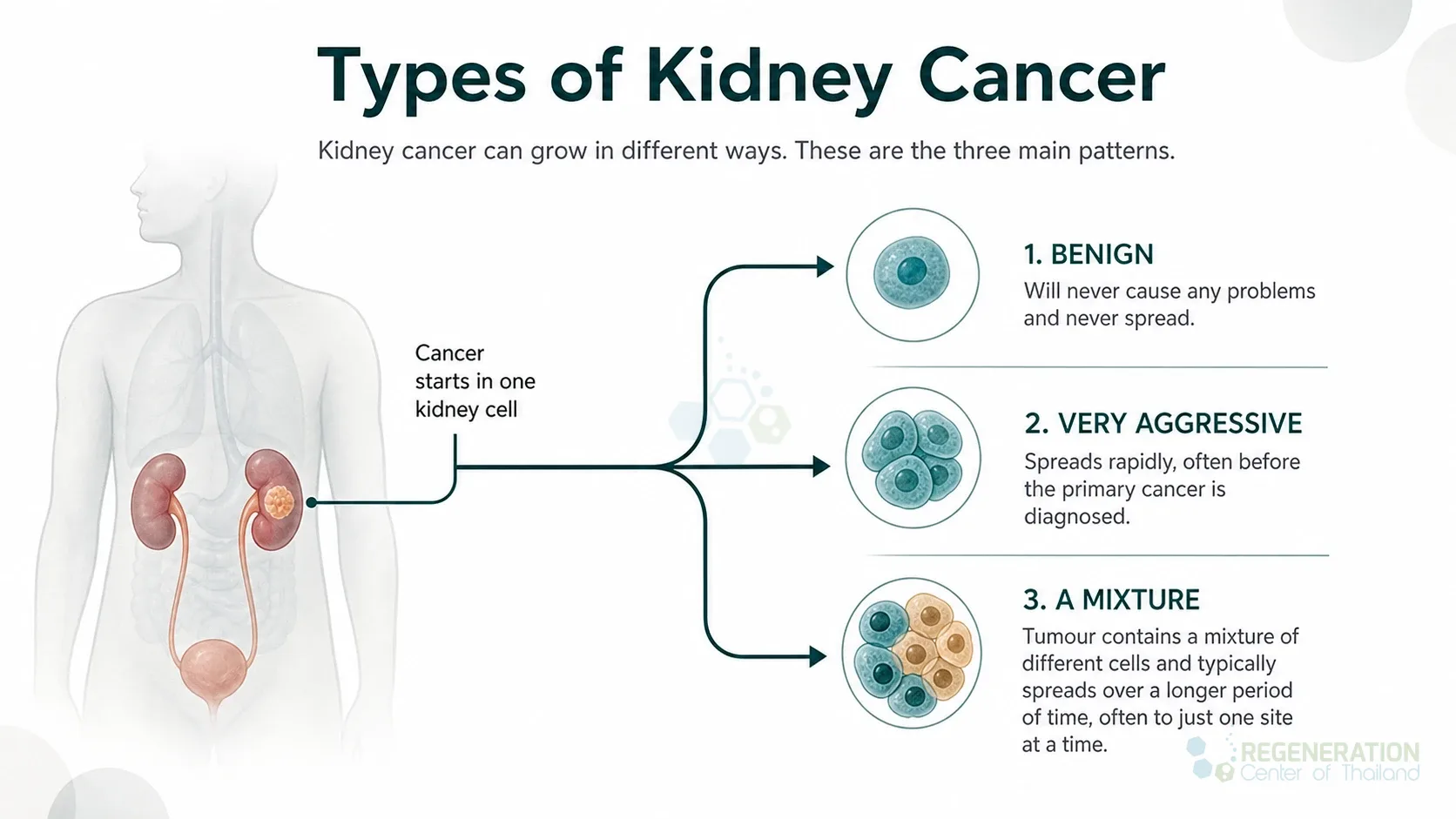 Clean clinical illustration for Types of Kidney Cancer with concise explanatory text.