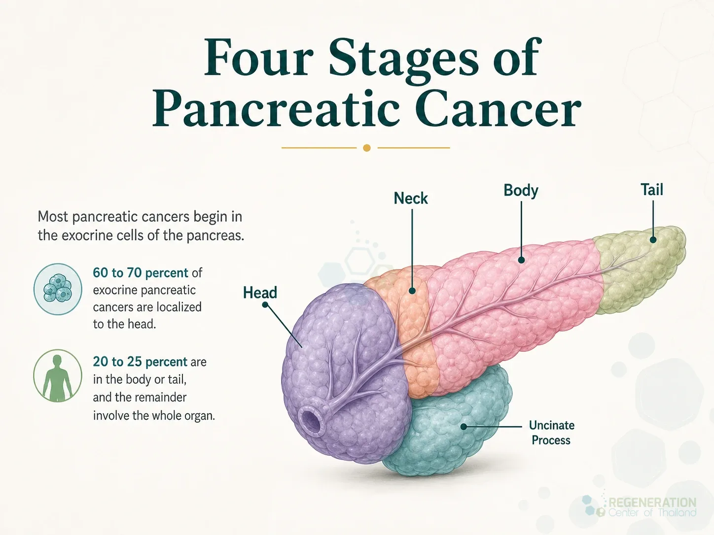 Clean clinical illustration for Four Stages of Pancreatic Cancer with concise explanatory text.