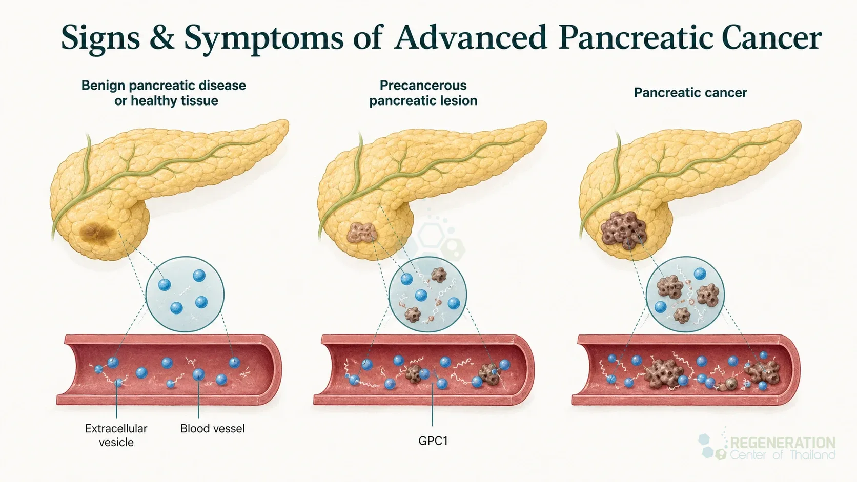 Clean clinical illustration for Signs & Symptoms of Advanced Pancreatic Cancer with concise explanatory text.