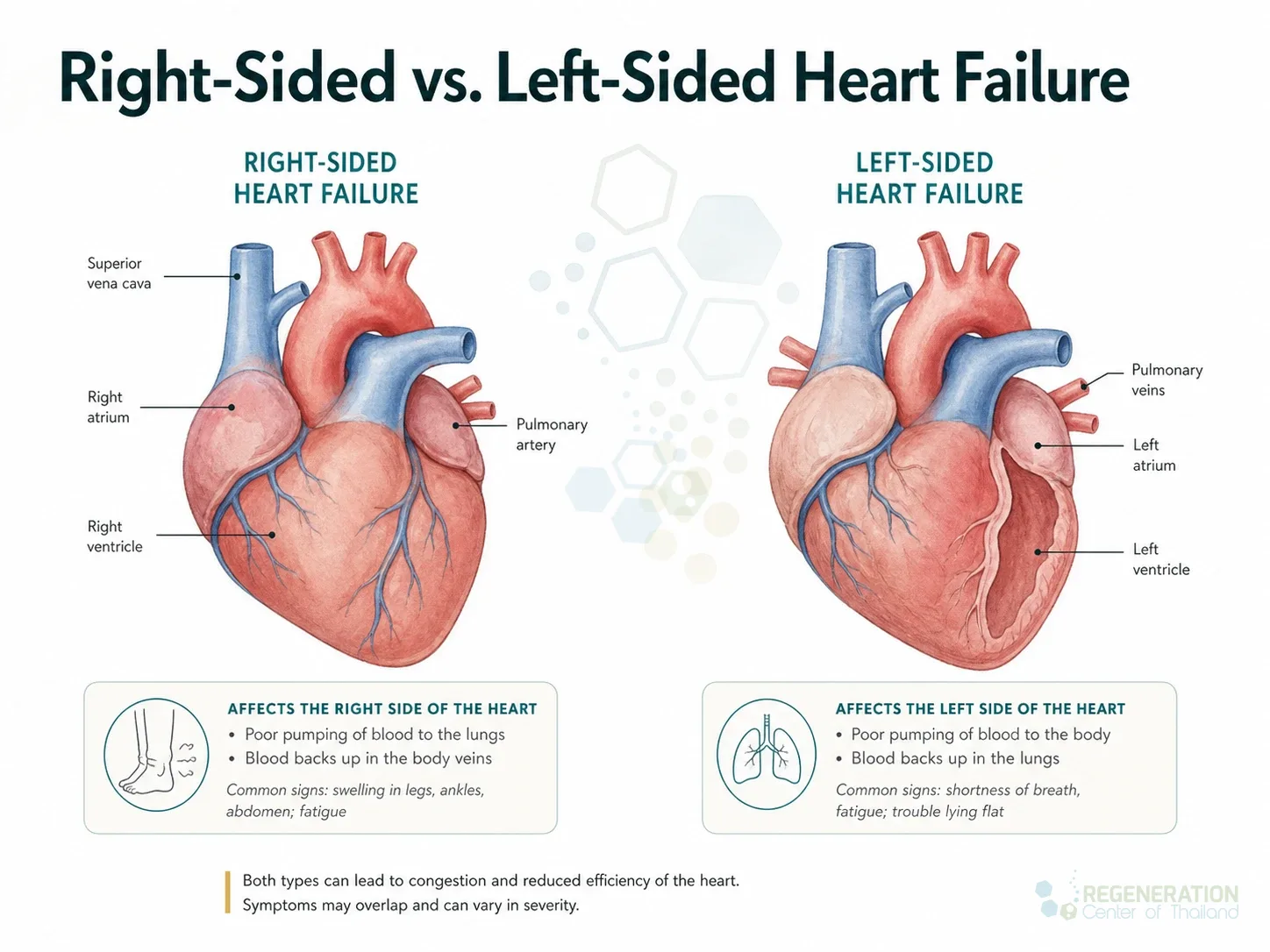 Clinical editorial image for Right-Sided vs. Left-Sided Heart Failure, including the section headline.