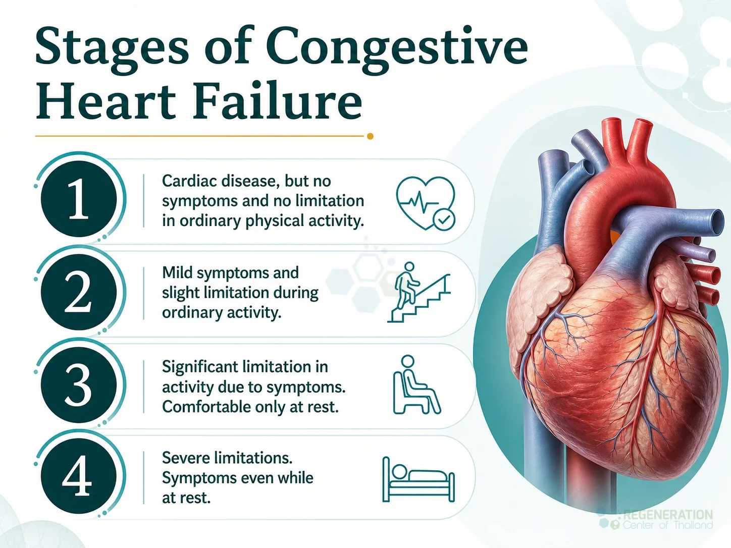 Editorial image for Stages of Congestive Heart Failure, including the section headline.