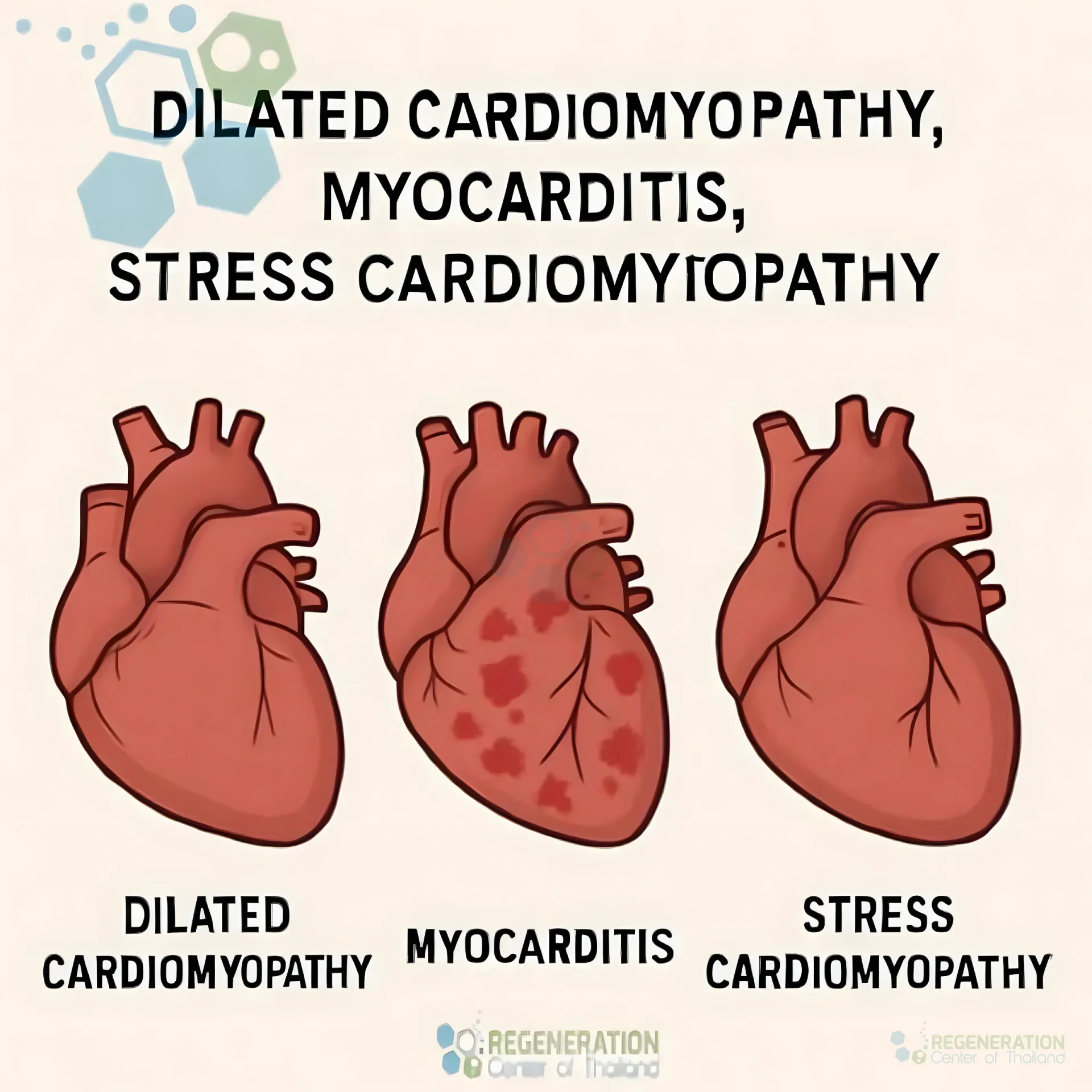 Illustration comparing dilated cardiomyopathy, myocarditis and stress cardiomyopathy for Cardiopoietic Stem Cell Treatment for Dilated Cardiomyopathy (DCM).
