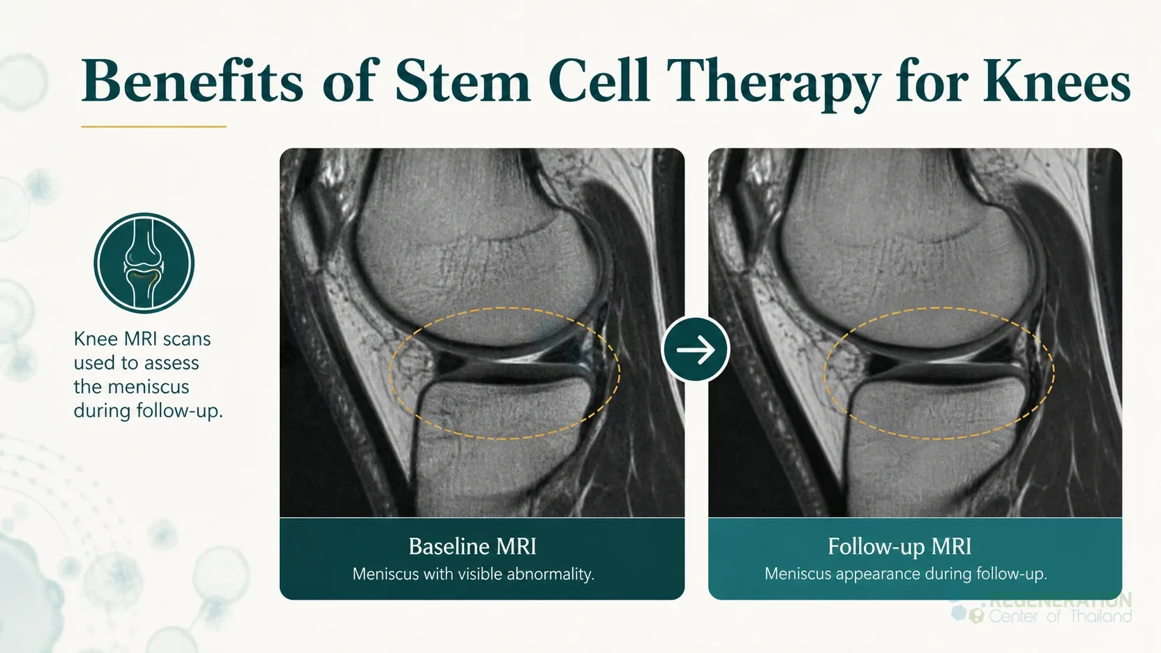 Clinical editorial image for Benefits of Stem Cell Therapy for Knees, including the section headline.