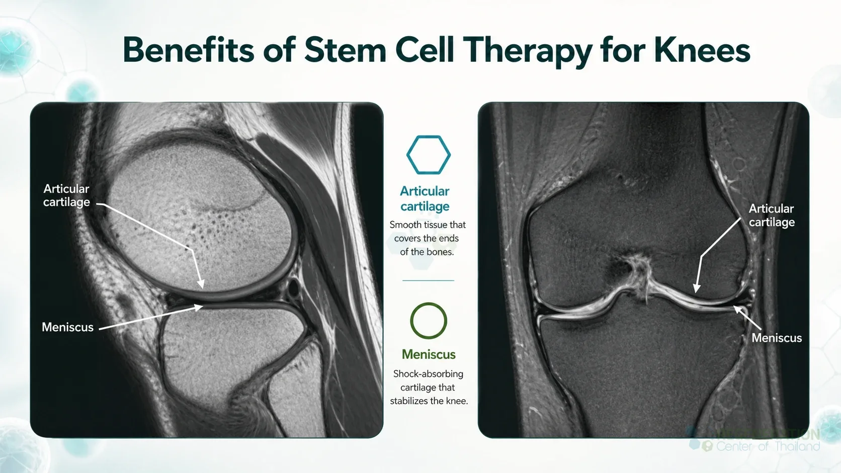 Editorial image for Benefits of Stem Cell Therapy for Knees, including the section headline.
