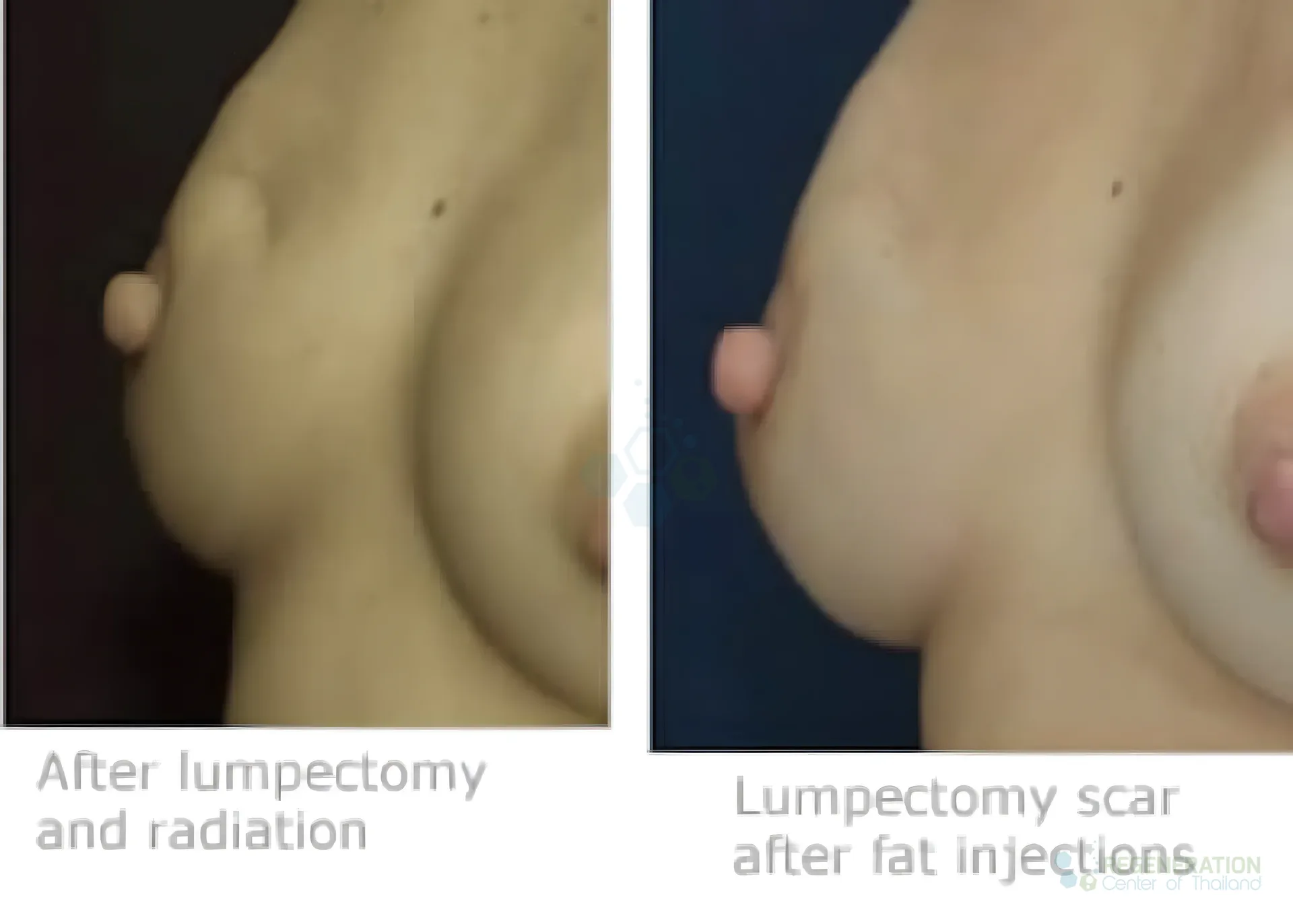 for Clinical photographs comparing a lumpectomy scar before and after fat injection treatment