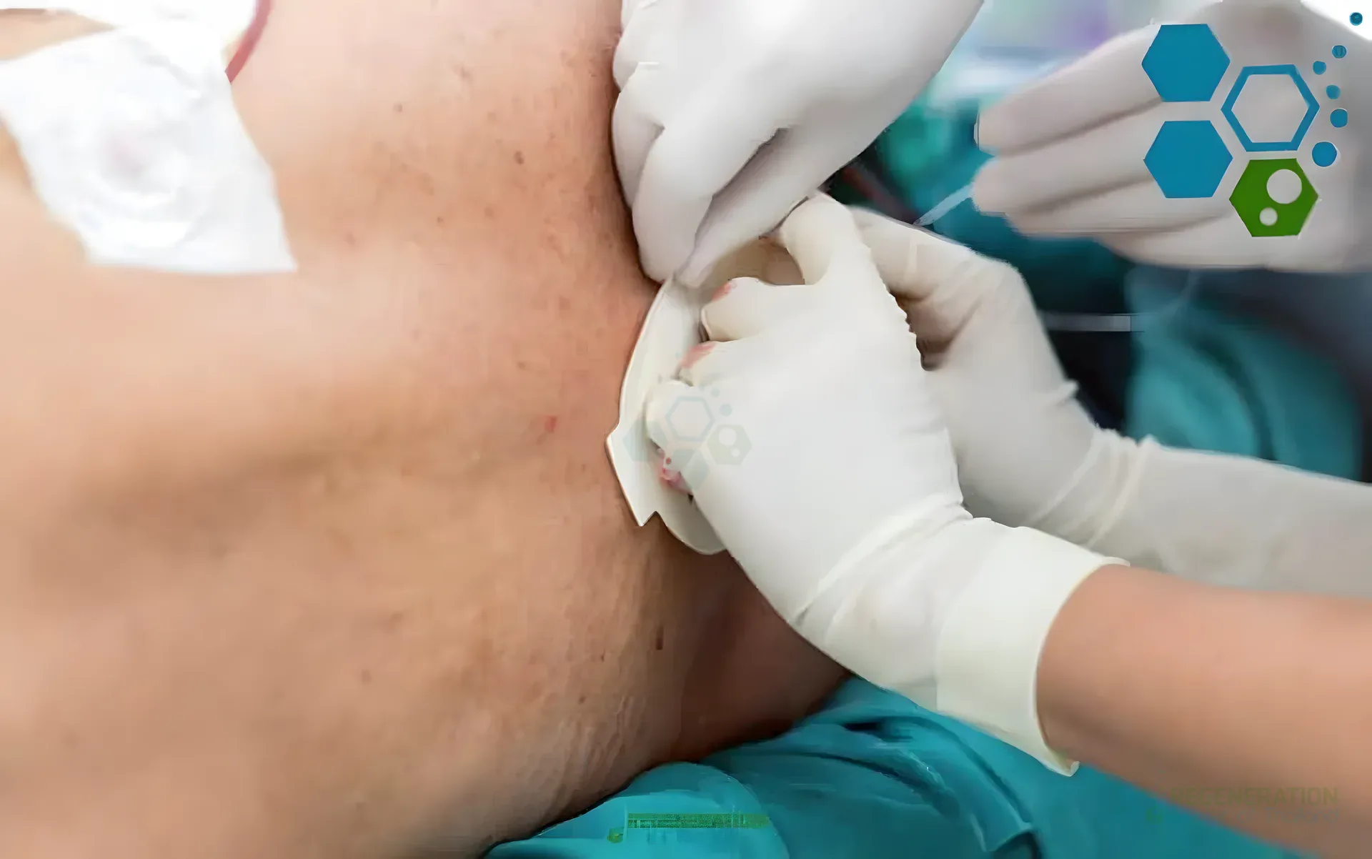 for Clinician performing a lumbar intrathecal injection on a patient lower back