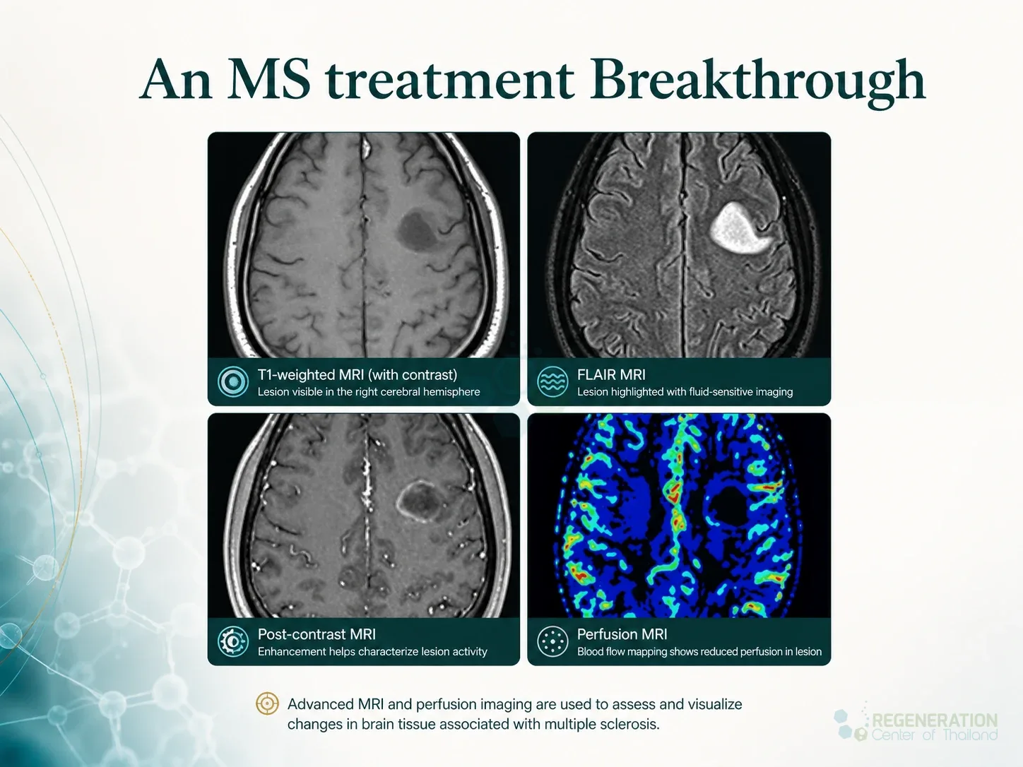Four MRI and perfusion brain scans used to assess neurological tissue changes for Fractalkine Cell Signaling Compound to Promote Remyelination.