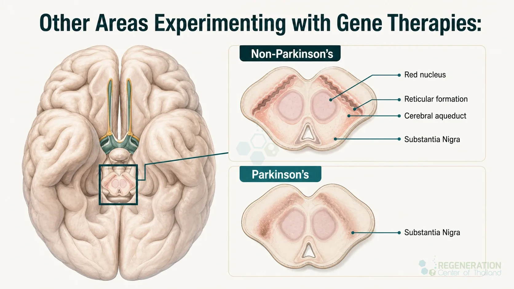 Parkinson brain anatomy, unverified draft for editorial review